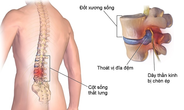 chụp thoát vị đĩa đệm cột sống thắt lưng