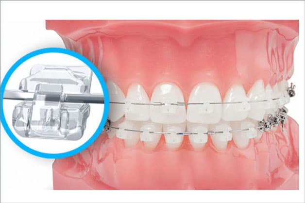 Phương pháp niềng răng mắc cài sứ tự buộc có thể rút ngắn thời gian niềng răng nhanh chóng