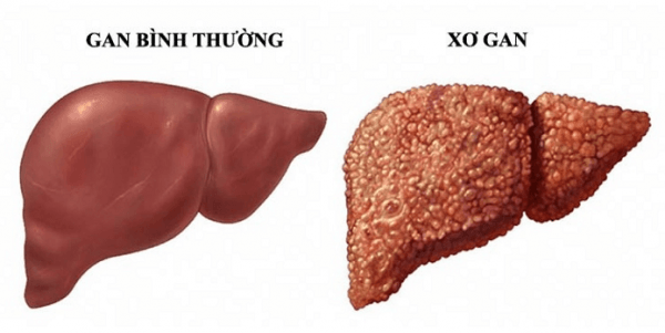 Viêm gan C có thể gây xơ gan