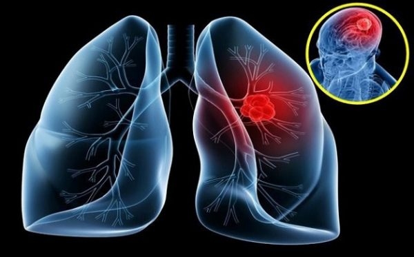Hóa trị trong ung thư phổi