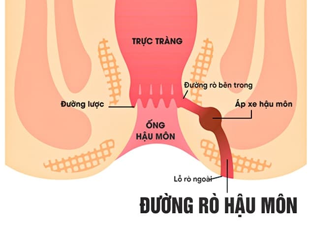 Rò hậu môn là một bệnh lý tiến triển từ các khối áp xe vùng hậu môn