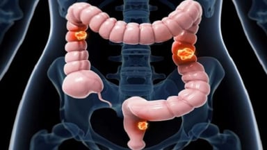 Ung thư đại tràng – Từ  A – Z các kiến thức cần lưu ý