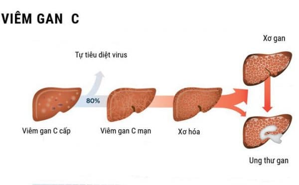 Viêm gan C tiến triển âm thầm dẫn đến các biến chứng xơ gan và ung thư