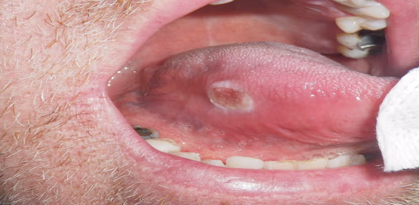 Bệnh ung thư khoang miệng có chữa được không?