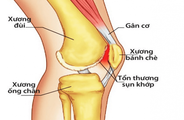 Đau khớp gối là tình trạng thường gặp