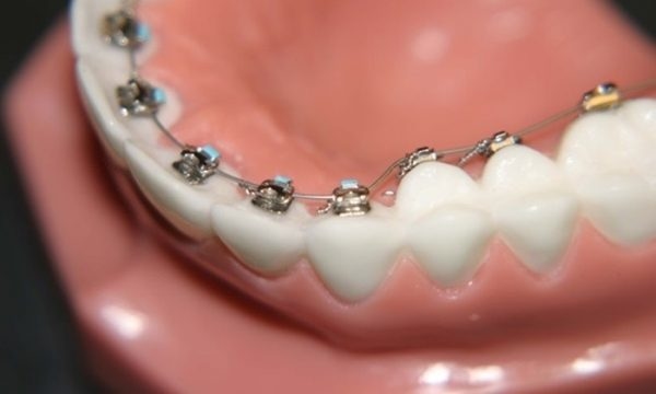 Niềng răng bên trong sử dụng khí cụ niềng, gắn trực tiếp vào bề mặt trong của răng
