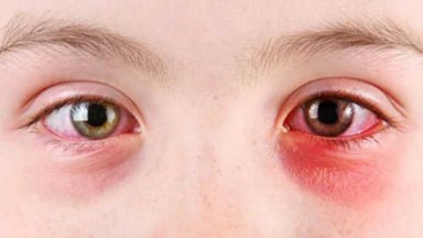 Tổng hợp những phương pháp điều trị đau mắt hột hiệu quả