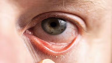 Viêm kết mạc dị ứng: Chẩn đoán và cách điều trị