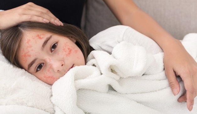 Bạn biết gì về xét nghiệm sởi tại nhà?