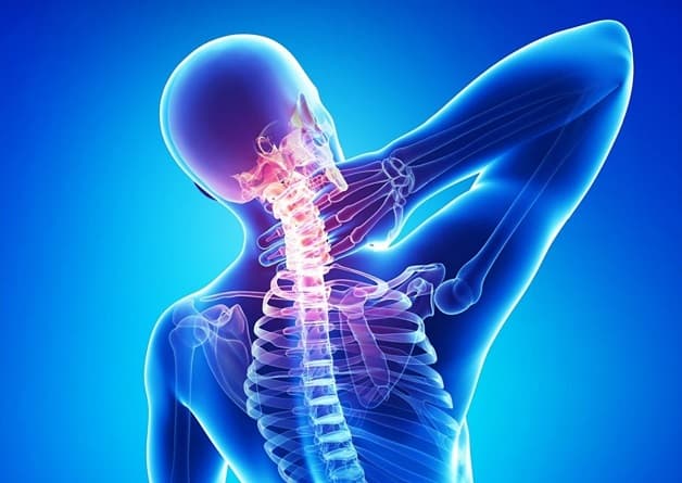 Ảnh 1: Vôi hóa đốt sống cổ gây ảnh hưởng nhiều đến sức khỏe và chất lượng cuộc sống - Tham khảo BV Thu Cúc.