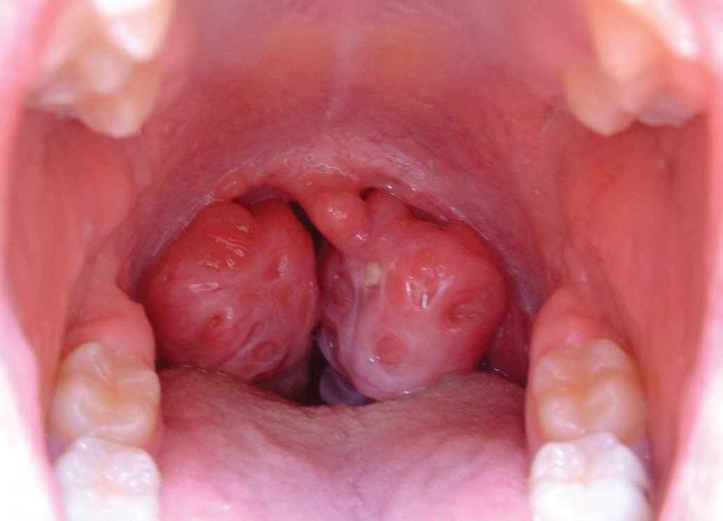 Các triệu chứng thường gặp của viêm amidan là là sốt, sưng amidan, đau họng, khô họng,...