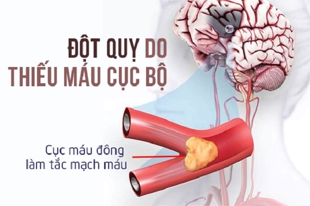 thiếu máu não dễ gây tai biến mạch máu não.