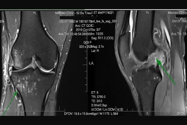 Chỉ định chụp cộng hưởng từ MRI trong chẩn đoán các bệnh về xương khớp