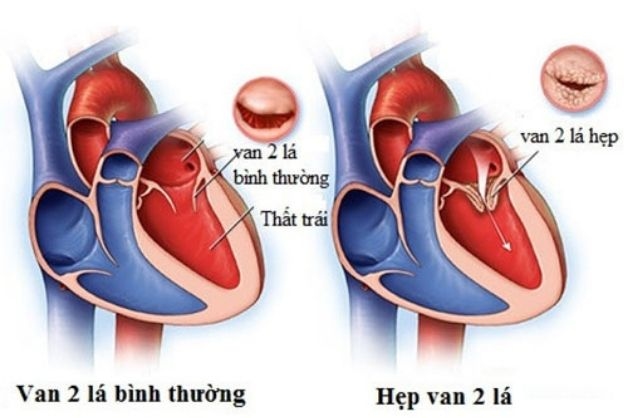 Nhiều bệnh lý tim mạch được phát hiện thông qua chẩn đoán hình ảnh X quang tim
