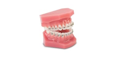 Chi phí niềng răng cho trẻ em giá bao nhiêu hiện nay?