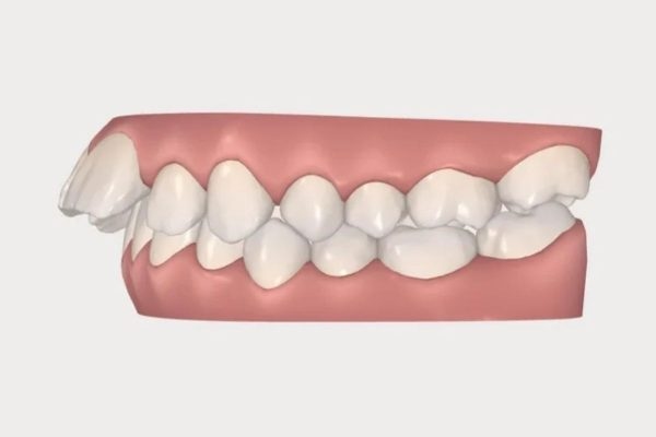 Tình trạng hô gây ra nhiều bất tiện trong sinh hoạt nên thường được bác sĩ khuyến khích niềng