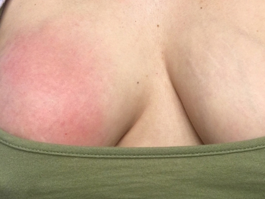 Tắc tia sữa nếu không khai thông sớm dễ dẫn đến nhiều biến chứng nguy hiểm cho mẹ như áp xe vú, viêm vú, u xơ tuyến vú,...