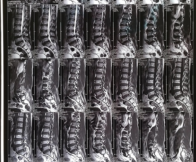chụp mri cho vùng cột sống