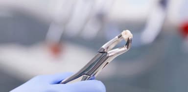 Giá nhổ răng khôn mọc lệch hiện nay cao bao nhiêu?