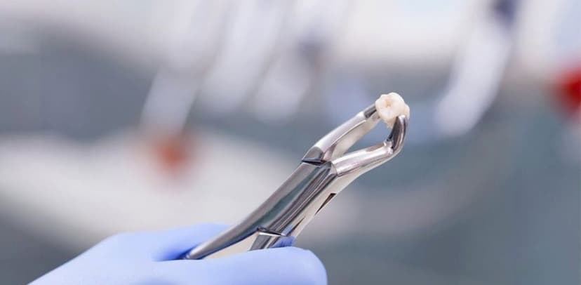 Giá nhổ răng khôn mọc lệch hiện nay cao bao nhiêu?