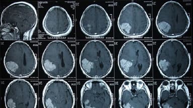 Giúp bạn hiểu rõ về kỹ thuật chụp CT sọ não