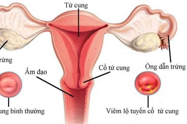 Viêm lộ tuyến tử cung