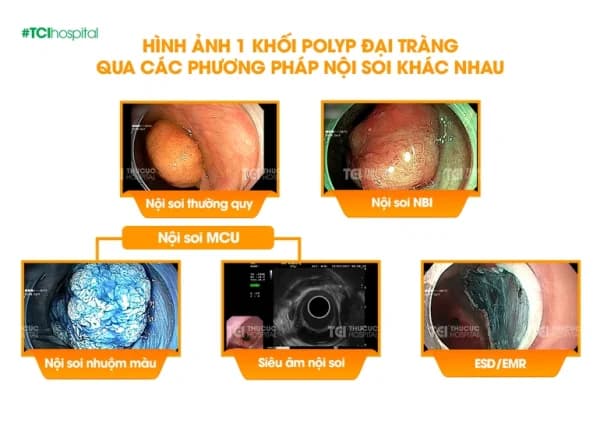 Đột phá công nghệ nội soi MCU