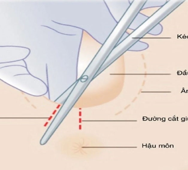 Đẻ thường rạch tầng sinh môn bao lâu thì lành là câu hỏi mẹ bầu quan tâm