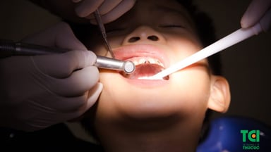 Bé bị sâu kẽ răng cửa, mẹ phải làm sao?