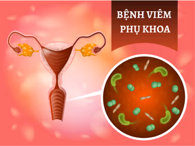 Khái niệm các bệnh về viêm phụ khoa là gì?