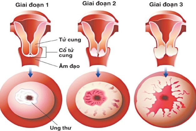 ung thư cổ tử cung
