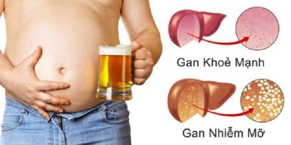 Gan nhiễm mỡ có nguy hiểm không
