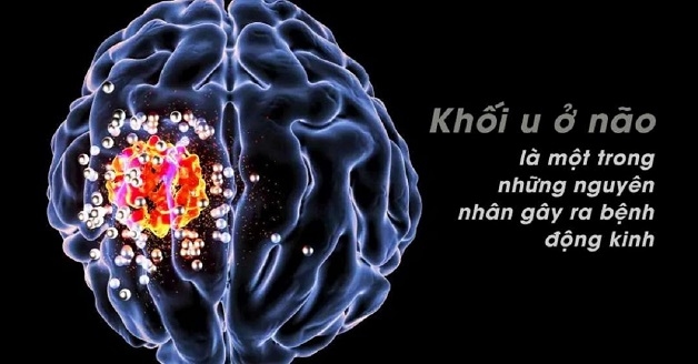 bệnh động kinh do u não gây ra