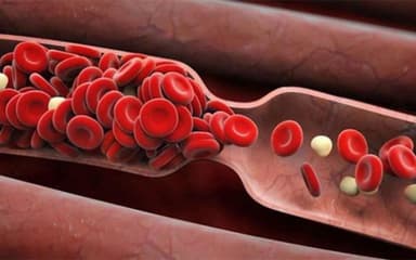 Cách làm lưu thông mạch máu não ngăn ngừa cơn tai biến