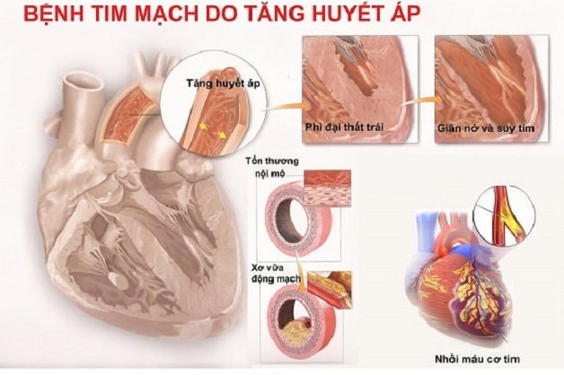 mất ngủ lâu ngày gây nhiều bệnh tim mạch