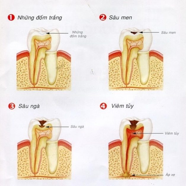 răng bị sâu