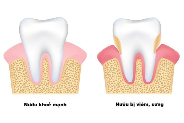 nướu răng đỏ