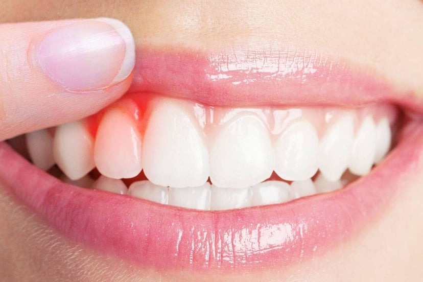 Nướu răng đỏ và những nguyên nhân khó ngờ tới