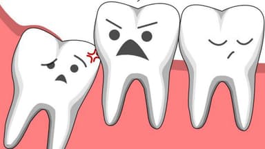 Răng 8 mọc lệch – “Quả bom nổ chậm” cần được xử lý sớm