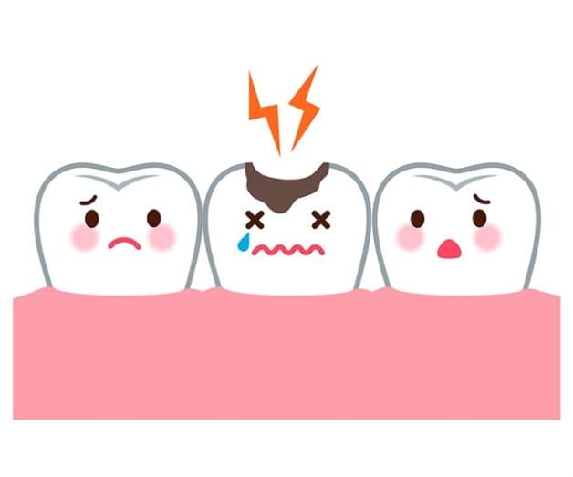 răng hàm bị sâu