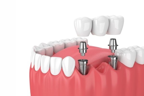 Cấy ghép implant phục hình răng bị mất với nhiều ưu điểm vượt trội nên được nhiều người lựa chọn