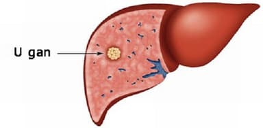 U gan có nguy hiểm không và những điều cần biết