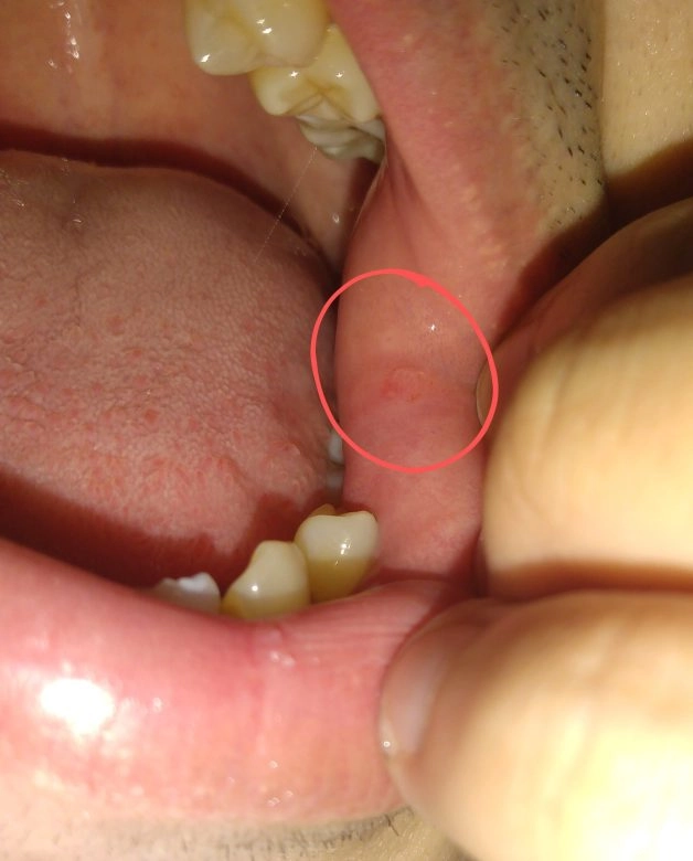 viêm niêm mạc má