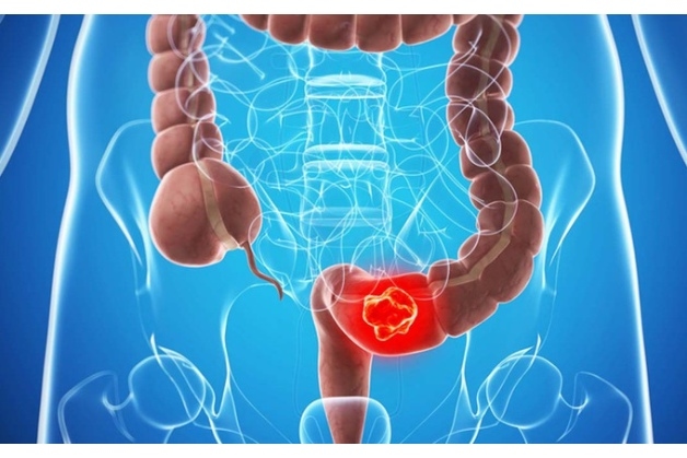 Tầm soát ung thư đại trực tràng như thế nào