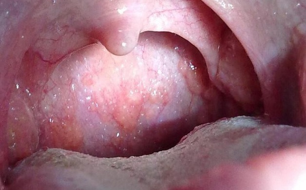nguyên nhân ung thư vòm họng là gì