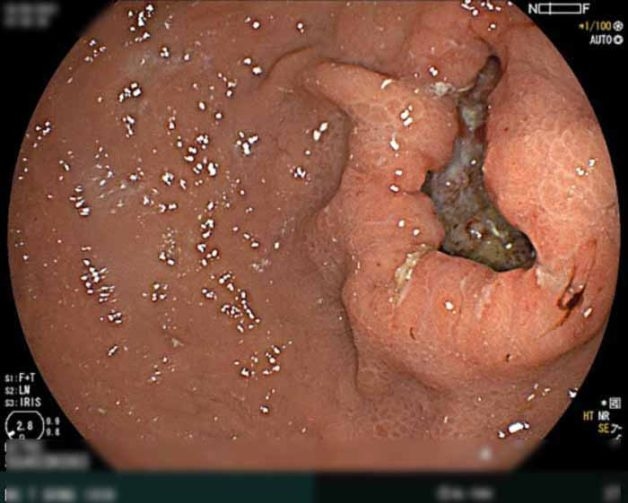 Ung thư dạ dày là biến chứng nguy hiển nếu không chữa trị kịp thời