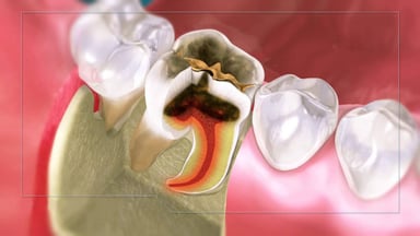 Cuống răng nằm ở đâu? Tại sao bị viêm cuống răng?