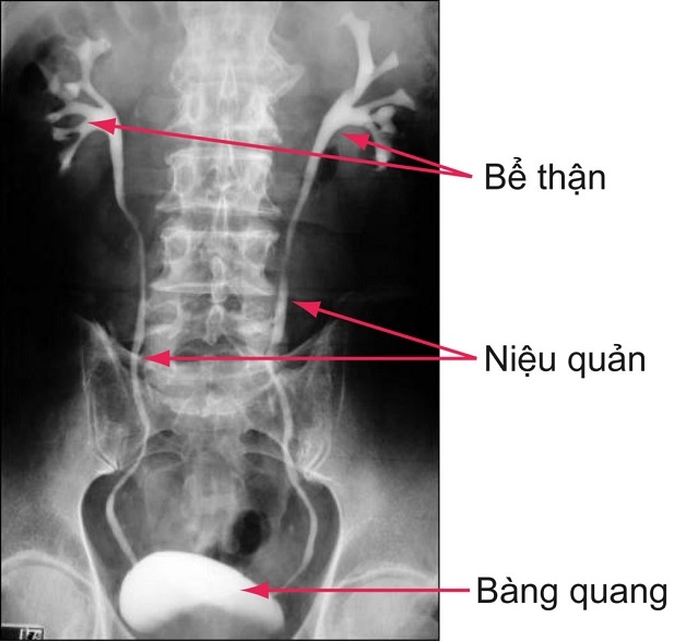 Chụp X-quang cho giúp xác định vị trí của sỏi