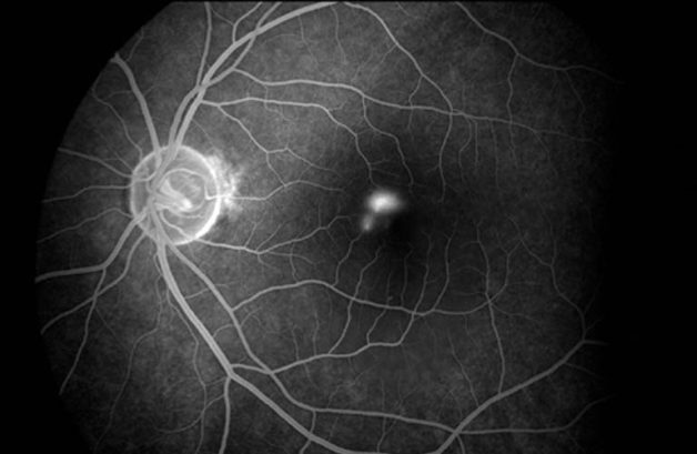 Hắc võng mạc trung tâm thanh dịch được chẩn đoán bằng soi đáy mắt