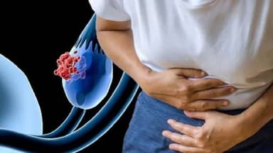 Giải đáp: Tầm soát ung thư buồng trứng như thế nào?